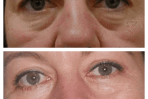 Eye Bag Removal