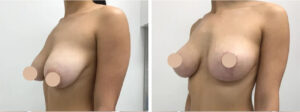 breast reduction in dubai