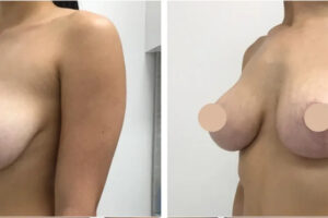 breast reduction in dubai