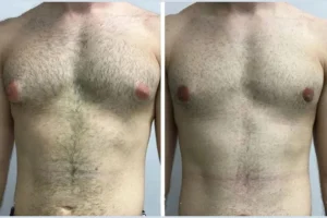 Top Clinics for Gynecomastia in Dubai: Where to Go for Male Breast Reduction