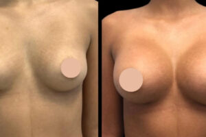 Minimally Invasive Options for Breast Augmentation in Dubai