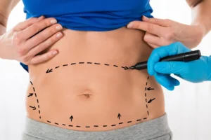 Abdominoplasty Dubai
