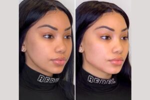 Thread Lift Treatment in Dubai: For Those Seeking a Light, Refreshed Lift