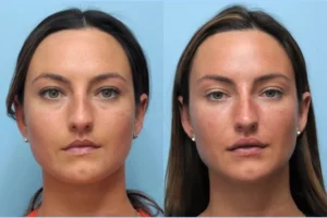 The Science Behind the Best Plastic Surgeon in Dubai for Thread Lift