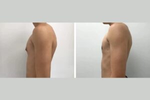 gynecomastia surgery