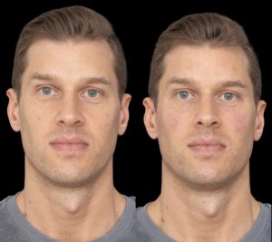 Under Eye Fillers in Dubai