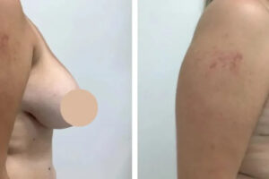 breast reduction in dubai