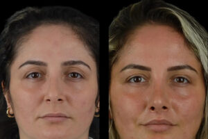 Cheek Fillers in Dubai