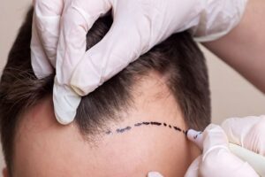 Hair Transplant in Riyadh