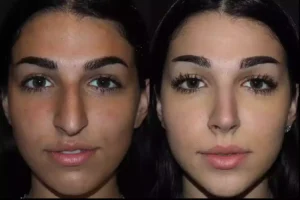 Septoplasty in Dubai