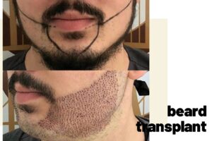 beard implants turkey