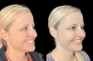 Your Complete Guide to Botox Treatments in Dubai for Smooth Skin