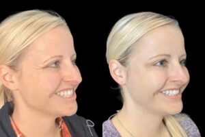 Your Complete Guide to Botox Treatments in Dubai for Smooth Skin
