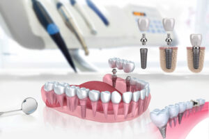 traitement implants dentaires
