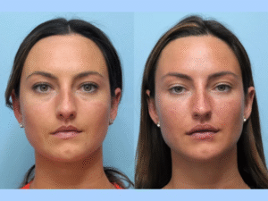 See the Difference with the Best Doctors in Dubai for Thread Lift