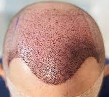 زراعة الشعر بتقنية FUE في ابوظبي