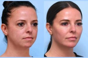Best Aesthetic Clinic in Dubai for Celebrity-Style Thread Lift