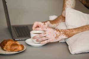 Vitiligo Treatment