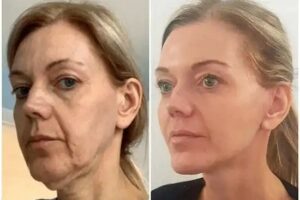 Profhilo treatments in dubai
