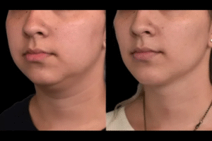 Double chin removal