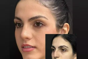 Rhinoplasty in Dubai