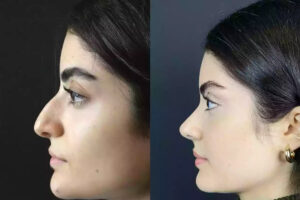 Rhinoplasty in Dubai
