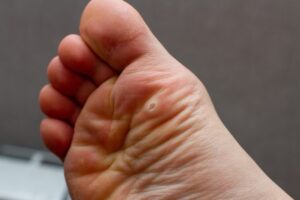 How Effective Is Laser for Warts Removal?
