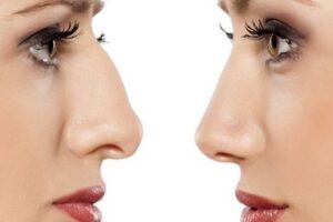 Rhinoplasty in Riyadh