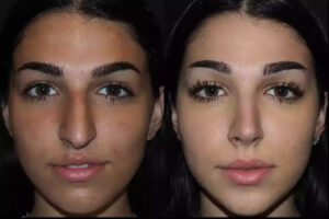 Septoplasty in Dubai