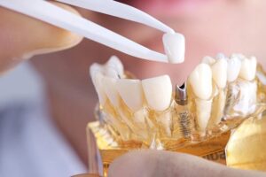 dental implant