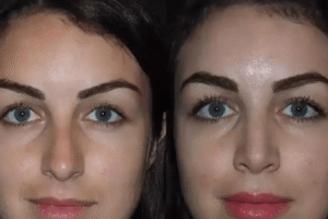 nose surgery in dubai