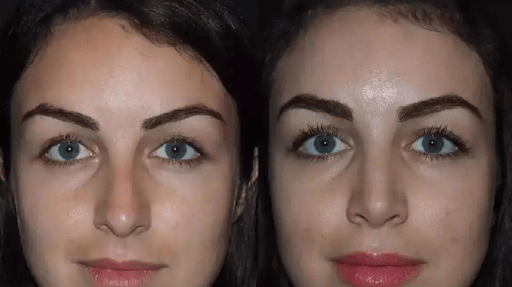nose surgery in dubai