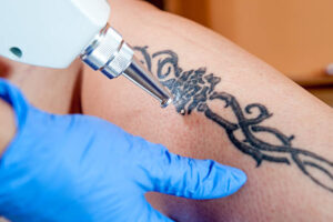 Can Laser Tattoo Removal Erase Colored Inks Easily