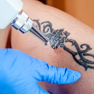 Can Laser Tattoo Removal Erase Colored Inks Easily