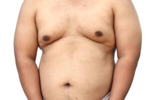 Gynecomastia Surgery in Riyadh