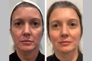 Best Doctors in Dubai Providing Thread Lift Treatments to Tighten and Define Your Face