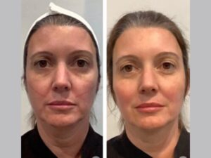 Best Doctors in Dubai Providing Thread Lift Treatments to Tighten and Define Your Face