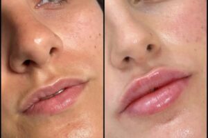 Fillers in Dubai