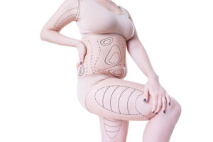 Is BodyTite Liposuction Safe for All Body Types