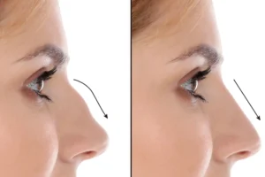 Rhinoplasty in Dubai