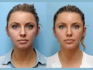 Thread Lift Treatments in Dubai: Minimal Downtime Maximum Results