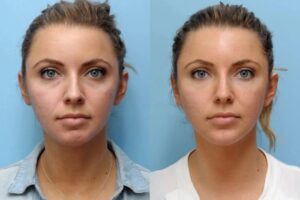 Achieve Younger Looking Skin with Professional Thread Lift Treatment in Dubai