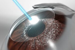 Everything You Need to Know About LASIK Laser Surgery at Sobti Nursing Home