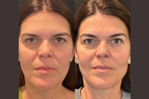 Thread Lift Treatment in Dubai: A Safe and Fast Solution for Skin Tightening