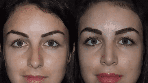 rhinoplasty in dubai