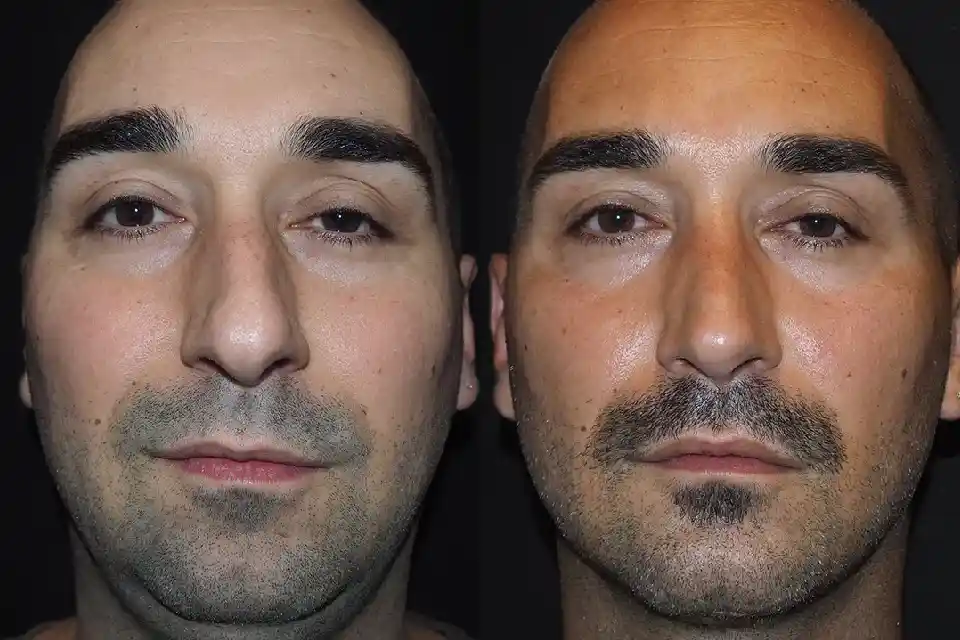 rhinoplasty in dubai