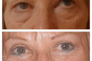 Eye Bag Removal