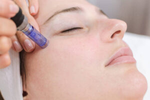 Does Fractional RF Micro Needling Help Deep Skin Renewal