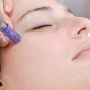 Does Fractional RF Micro Needling Help Deep Skin Renewal