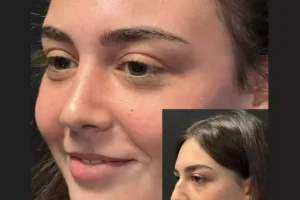 septoplasty in dubai